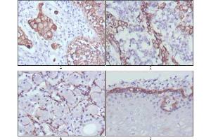 Immunohistochemical analysis of paraffin-embedded human lung cancer (A), endometrial carcinoma (B), sublingual gland (C) and esophagus (D) tissues using CK17 mouse mAb with DAB staining. (KRT17 anticorps)