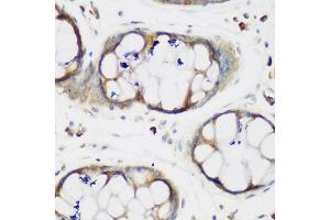 Immunohistochemistry of paraffin-embedded human gastric using MTDH antibody (ABIN5975399) at dilution of 1/200 (40x lens). (MTDH anticorps)