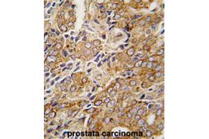 Formalin-fixed and paraffin-embedded human prostate carcinomareacted with TRPM8 polyclonal antibody , which was peroxidase-conjugated to the secondary antibody, followed by AEC staining.
