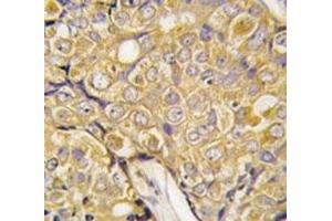 IHC analysis of FFPE human prostate carcinoma tissue stained with TRPM8 antibody