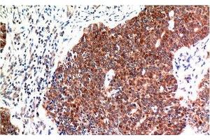 Immunohistochemistry of paraffin-embedded Human breast carcinoma tissue using BECN1 Monoclonal Antibody at dilution of 1:200. (Beclin 1 anticorps)