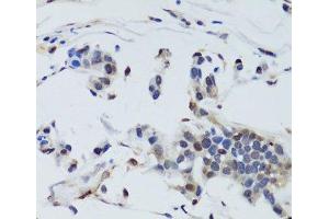 Immunohistochemistry of paraffin-embedded Human gastric cancer using DNMT1 Polyclonal Antibody at dilution of 1:200 (40x lens). (DNMT1 anticorps)