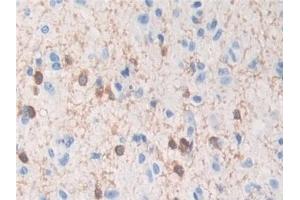 Detection of TPPP in Human Glioma Tissue using Polyclonal Antibody to Tubulin Polymerization Promoting Protein (TPPP) (Tppp anticorps  (AA 8-210))
