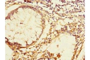 Immunohistochemistry of paraffin-embedded human colon cancer using ABIN7171814 at dilution of 1:100 (TEX43 anticorps  (AA 1-134))