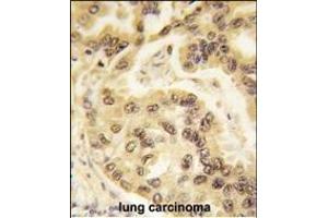Formalin-fixed and paraffin-embedded human lung carcinoma tissue reacted with p53 Antibody  h , which was peroxidase-conjugated to the secondary antibody, followed by DAB staining. (p53 anticorps  (AA 293-322))