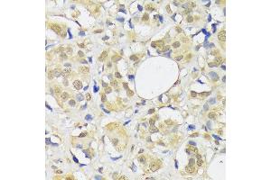 Immunohistochemistry of paraffin-embedded human breast cancer using  antibody (ABIN1678593, ABIN3018971, ABIN3018972 and ABIN6220651) at dilution of 1:100 (40x lens). (ADRM1 anticorps  (AA 108-407))