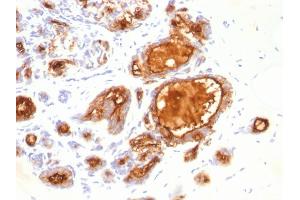 Formalin-fixed, paraffin-embedded human Breast Carcinoma stained with MUC1 Mouse Monoclonal Antibody (115D8).