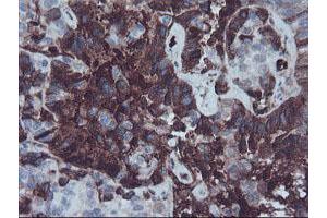 Immunohistochemical staining of paraffin-embedded Adenocarcinoma of Human ovary tissue using anti-AHSG mouse monoclonal antibody.