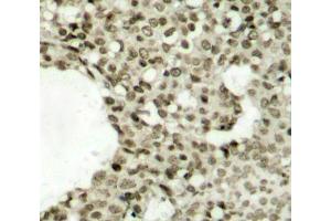 Immunohistochemistry of paraffin-embedded human breast carcinoma tissue, using Phospho-STAT1-S727 antibody (ABIN2988310). (STAT1 anticorps  (pSer727))