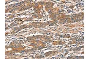 The image on the left is immunohistochemistry of paraffin-embedded Human gastic cancer tissue using ABIN7129096(CUEDC2 Antibody) at dilution 1/30, on the right is treated with fusion protein. (CUEDC2 anticorps)