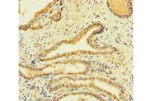 Immunohistochemistry of paraffin-embedded human prostate cancer using ABIN7155180 at dilution of 1:100