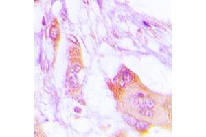 Immunohistochemical analysis of MARK staining in human lung cancer formalin fixed paraffin embedded tissue section. (MARK1 anticorps  (Center))