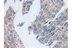 Detection of UTRN in Human Prostate cancer Tissue using Polyclonal Antibody to Utrophin (UTRN)