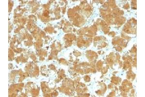 IHC testing of FFPE human thyroid carcinoma with TSHR antibody (clone TSHRA/1402).