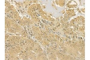 ABIN6263086 and ABIN6277126 at 1/100 staining human lung adenocarcinoma by IHC-P. (MALT1 anticorps  (Internal Region))