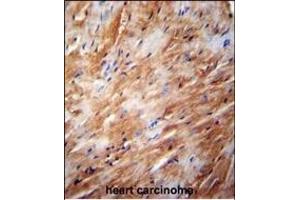 TFB2M Antibody (C-term) (ABIN654104 and ABIN2843988) immunohistochemistry analysis in formalin fixed and paraffin embedded human heart carcinoma followed by peroxidase conjugation of the secondary antibody and DAB staining. (TFB2M anticorps  (C-Term))
