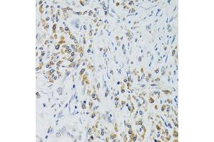 Immunohistochemistry of paraffin-embedded human colon carcinoma using SRP19 antibody (ABIN2560139) at dilution of 1:100 (40x lens). (SRP19 anticorps)