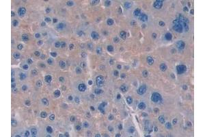 Detection of IL15 in Human Liver cancer Tissue using Polyclonal Antibody to Interleukin 15 (IL15)