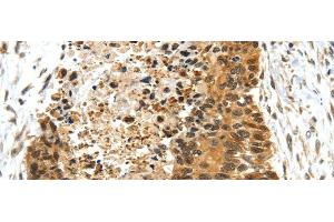 Immunohistochemistry of paraffin-embedded Human esophagus cancer using NR2F2 Polyclonal Antibody at dilution of 1/25