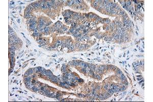 Immunohistochemistry (IHC) image for anti-Insulin-Like Growth Factor 2 mRNA Binding Protein 2 (IGF2BP2) antibody (ABIN1498821) (IGF2BP2 anticorps)