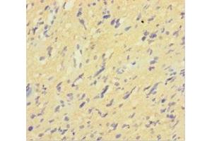 Immunohistochemistry of paraffin-embedded human glioma using ABIN7156965 at dilution of 1:100