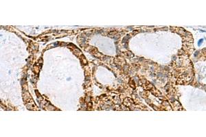 Immunohistochemistry of paraffin-embedded Human thyroid cancer tissue using MED31 Polyclonal Antibody at dilution of 1:100(x200) (MED31 anticorps)
