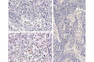 Immunohistochemistry of HumanIL1beta_antibod Tissue: medullary lymph node Fixation: formalin fixed paraffin embedded Antigen retrieval: user optimized Primary antibody: Human IL1beta antibody Secondary antibody: Peroxidase goat anti-rabbit at 1:10,000 for 45 min at RT Localization: cytoplasm Staining: Close up of medullary lymph node: positive staining in the cytoplasm of circulating macrophages. (IL-1 beta anticorps  (Cleavage Site, N-Term))