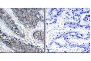 Immunohistochemical analysis of paraffin-embedded human breast carcinoma tissue, using IRS-1 (phospho-Ser307) antibody (E011235). (IRS1 anticorps  (pSer307))