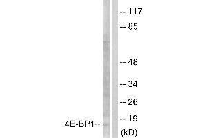 Immunohistochemical analysis of paraffin-embedded human colon carcinoma tissue using 4E-BP1 (Ab-64) antibody. (eIF4EBP1 anticorps  (Ser65))