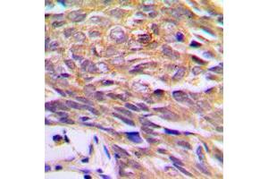 Immunohistochemical analysis of p23 staining in human prostate cancer formalin fixed paraffin embedded tissue section.