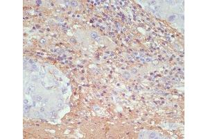 Immunohistochemistry of paraffin-embedded Human liver cancer using COL1A1 Polyclonal Antibody at dilution of 1:200 (40x lens). (COL1A1 anticorps)