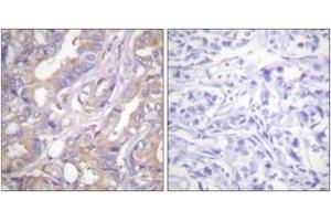 Immunohistochemistry analysis of paraffin-embedded human breast carcinoma tissue, using A-RAF (Ab-301/302) Antibody. (ARAF anticorps  (AA 276-325))