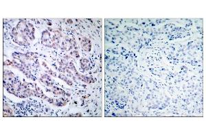 Immunohistochemical analysis of paraffin-embedded human breast carcinoma tissue, using TYK2 (Ab-1054) antibody (E021118). (TYK2 anticorps)