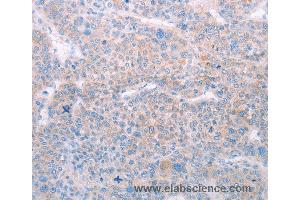 Immunohistochemistry of Human lung cancer using SPATA6 Polyclonal Antibody at dilution of 1:50 (SPATA6 anticorps)