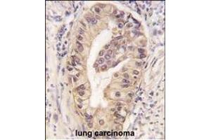 Formalin-fixed and paraffin-embedded human lung carcinoma tissue reacted with ATG16L1 Monoclonal Antibody (ABIN6243484 and ABIN6577053) , which was peroxidase-conjugated to the secondary antibody, followed by DAB staining.