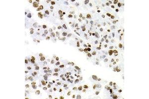 Immunohistochemistry of paraffin-embedded human liver cancer using NFKB2 Antibody.