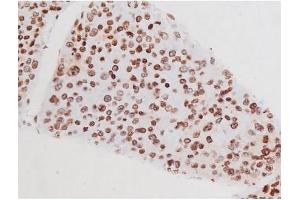 ABIN6267365 at 1/200 staining Human liver cancer tissue sections by IHC-P.
