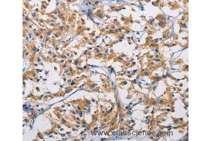 Immunohistochemistry of Human colon cancer using HK1 Polyclonal Antibody at dilution of 1:50 (Hexokinase 1 anticorps)