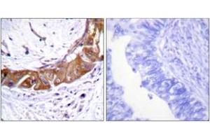 Immunohistochemistry analysis of paraffin-embedded human colon carcinoma, using IRAK1 (Phospho-Thr100) Antibody.