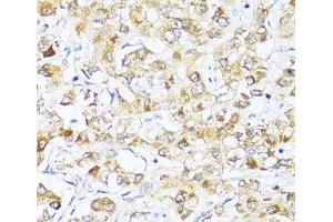 Immunohistochemistry of paraffin-embedded Human liver cancer using EIF2S1 Polyclonal Antibody at dilution of 1:100 (40x lens).