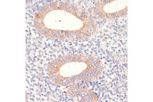 Immunohistochemistry of paraffin-embedded human uterine cancer using HMGCR antibody (ABIN3022293, ABIN3022294, ABIN3022295, ABIN1513022 and ABIN6218714) at dilution of 1:200 (40x lens).