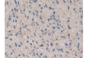 Detection of CPB1 in Human Glioma Tissue using Polyclonal Antibody to Carboxypeptidase B1, Tissue (CPB1) (CPB1 anticorps  (AA 111-417))