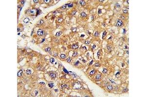 IHC analysis of FFPE human hepatocarcinoma stained with GARP antibody