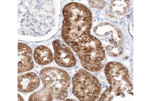 ABIN6267641 at 1/200 staining human kidney carcinoma tissue sections by IHC-P. (eIF4EBP1 anticorps  (pThr45))