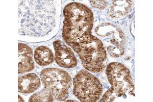 ABIN6267641 at 1/200 staining human kidney carcinoma tissue sections by IHC-P.