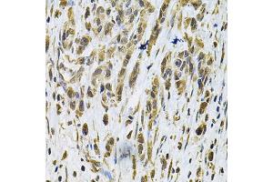 Immunohistochemistry of paraffin-embedded human gastric cancer using RhoA Antibody (ABIN6292258) at dilution of 1:100 (40x lens). (RHOA anticorps)