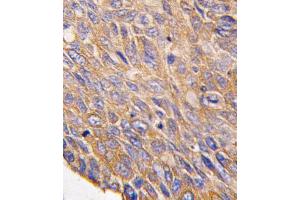 Formalin-fixed and paraffin-embedded human lung carcinoma tissue reacted with TOB2 antibody (N-term), which was peroxidase-conjugated to the secondary antibody, followed by DAB staining. (TOB2 anticorps  (N-Term))