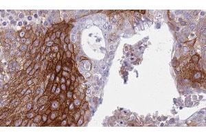 ABIN6272334 at 1/100 staining Human urothelial cancer tissue by IHC-P.