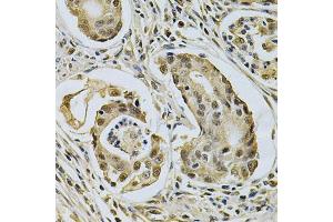 Immunohistochemistry of paraffin-embedded human gastric cancer using LGALS3 Antibody (ABIN5970683) at dilution of 1/200 (40x lens). (Galectin 3 anticorps)
