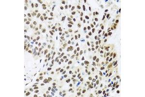Immunohistochemistry of paraffin-embedded human lung cancer using FUBP1 antibody (ABIN6130392, ABIN6140802, ABIN6140804 and ABIN6221231) at dilution of 1:100 (40x lens). (FUBP1 anticorps  (AA 302-644))